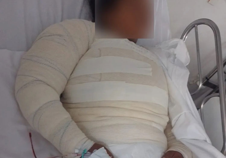 Mulher tem 50% do corpo queimado após ser atacada com água fervente em Santo Amaro