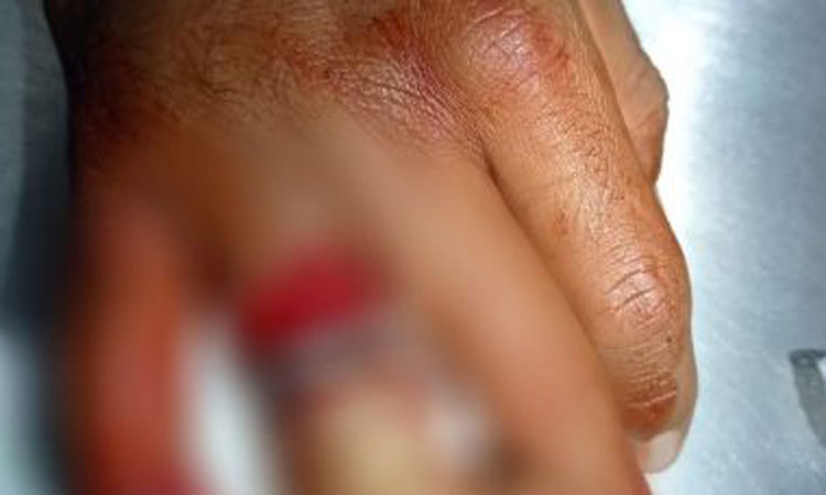 Vitória da Conquista: Bombeiros retiram anel de jovem que prendeu o dedo numa caçamba