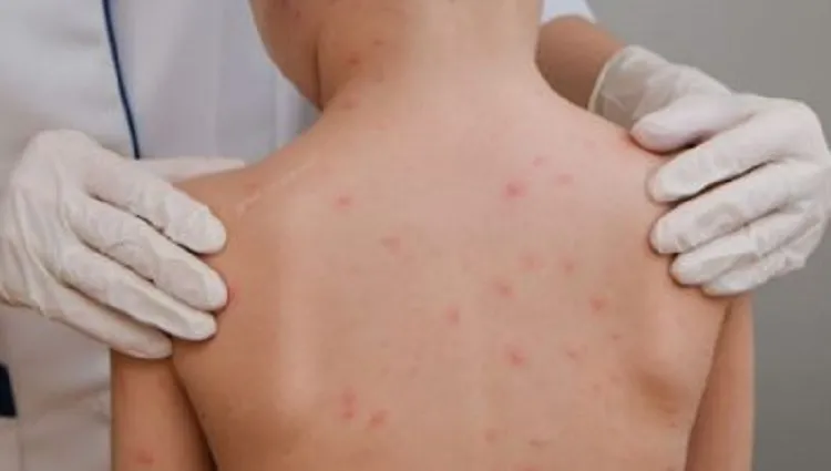 Bahia registra mais de 250 casos de meningite nos oito meses de 2023