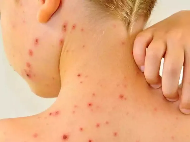 Núcleo Regional intensifica ações e campanhas de prevenção a catapora no Sudoeste da Bahia