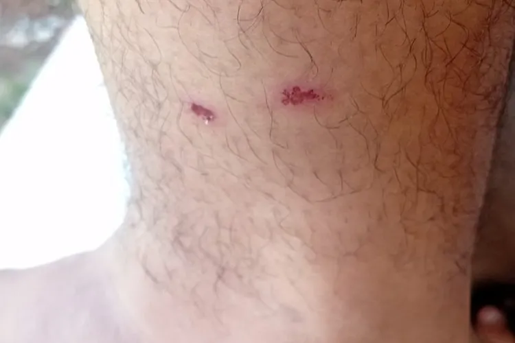 'Foi traiçoeiro', diz homem mordido por cães enquanto seguia para o trabalho em Brumado