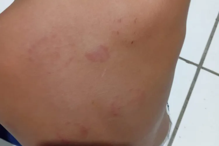 Criança de três anos é mordida nove vezes por colega dentro de creche em Guanambi