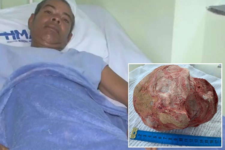 Lavrador que teve pedra de 1,3 Kg e 18 cm retirada da bexiga tem alta em Jacobina