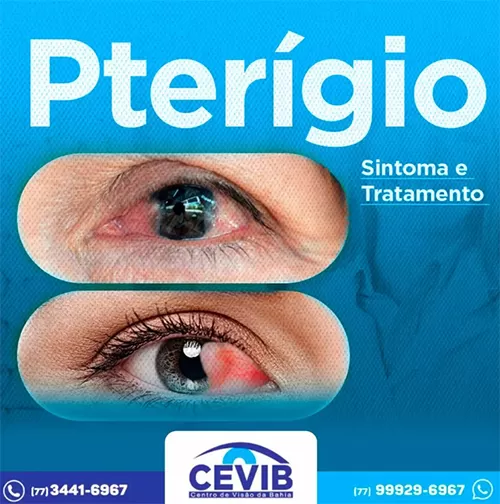 Cevib: Saiba o que é e quais as causas do pterígio