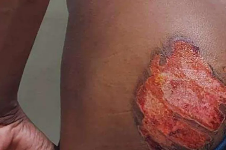 Livramento de Nossa Senhora: Irmãos são presos acusados de marcar jovem negro e surdo-mudo com ferro quente nas nádegas