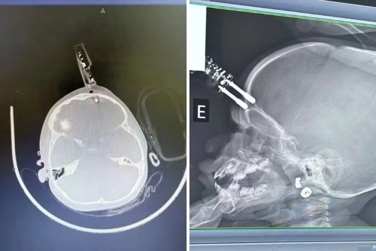 Bebê de um ano cai e fica com carregador de celular preso ao crânio