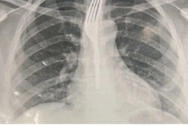 Mulher engole garfo durante refeição em Guanambi