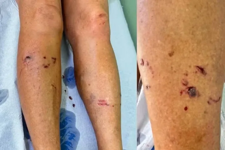 Mulher é atacada por raposa durante caminhada em Cruz das Almas