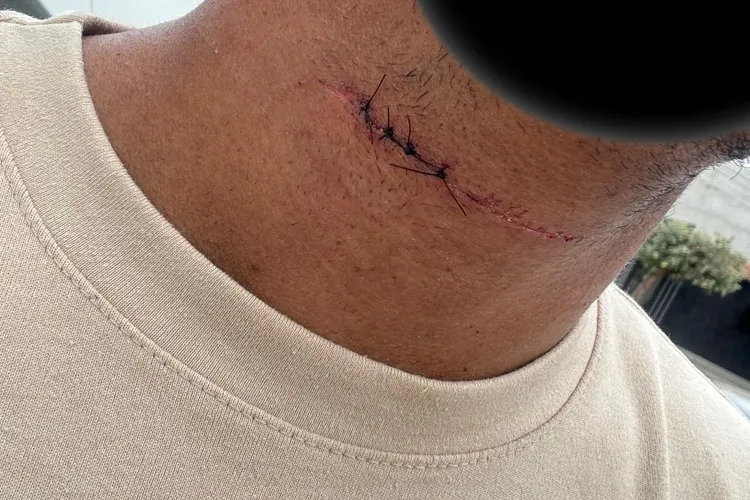 Linha com cerol quase decepa pescoço de estudante de Direito no dia da formatura em Brumado