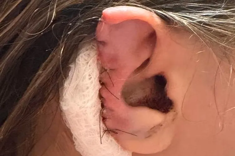 São Paulo: Homem morde e arranca pedaço da orelha da companheira em restaurante