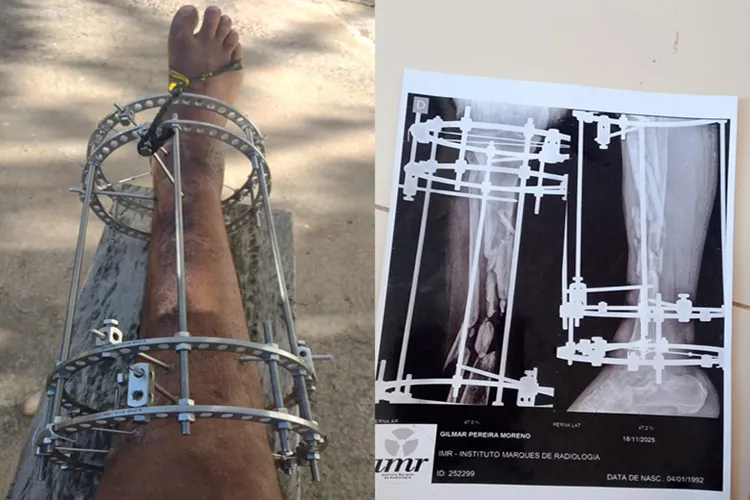 'Misericórdia de Deus': mãe narra 2 anos de espera por cirurgia do filho em Guanambi