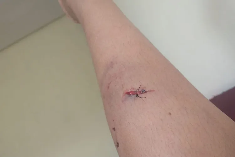 Motociclista é atacada por cão de rua e tem perna ferida em Livramento de Nossa Senhora