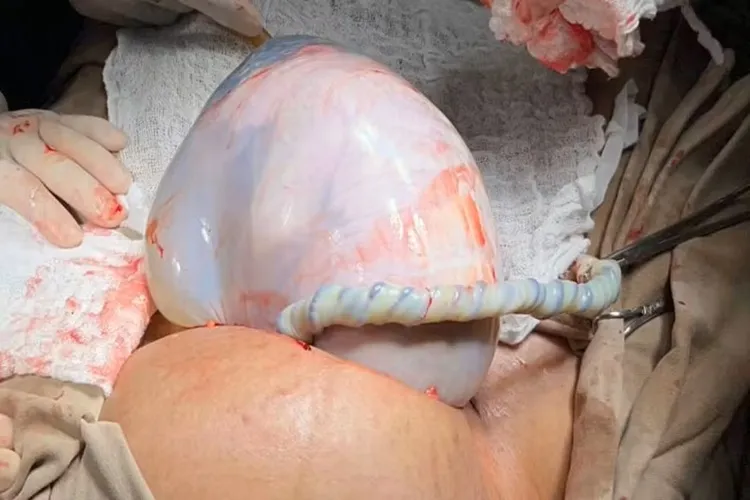 Caso raro em Irecê: Bebê nasce empelicada, mas irmã gêmea não