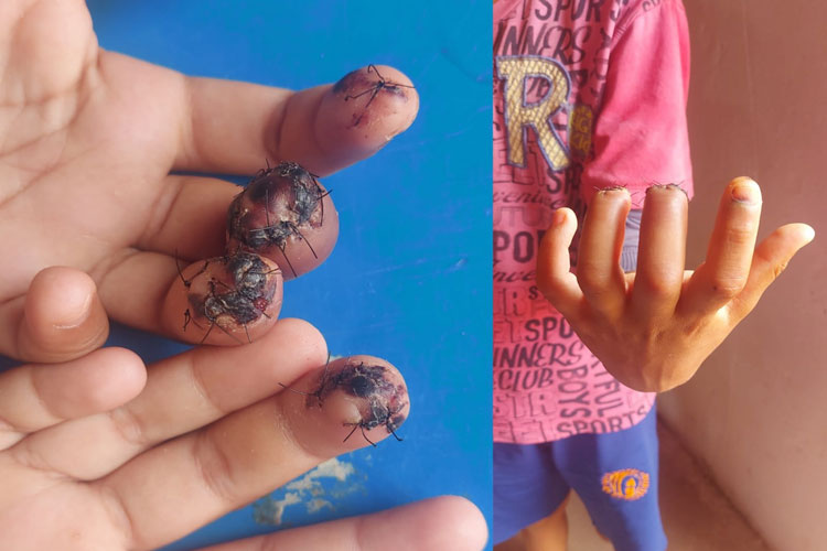 Brumado: Criança aguarda assistência após perder cabeça dos dedos em acidente em escola