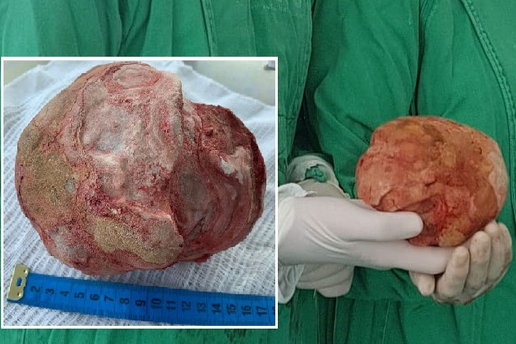 Jacobina: Lavrador de 51 anos tem pedra de 1,3 Kg e 18 cm retirada da bexiga durante cirurgia