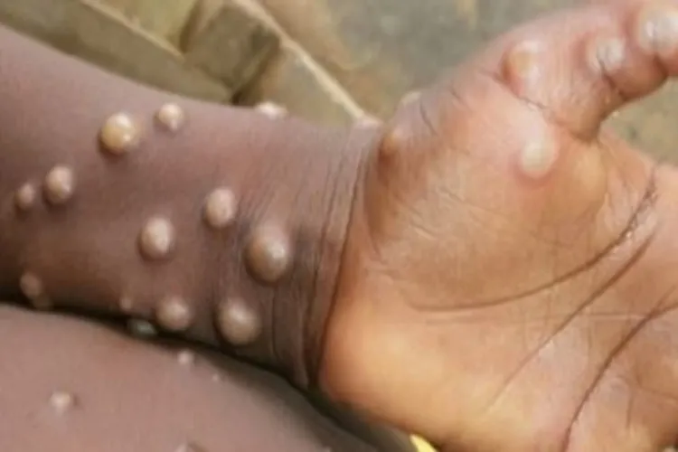 Região Norte do Brasil registra casos de mpox