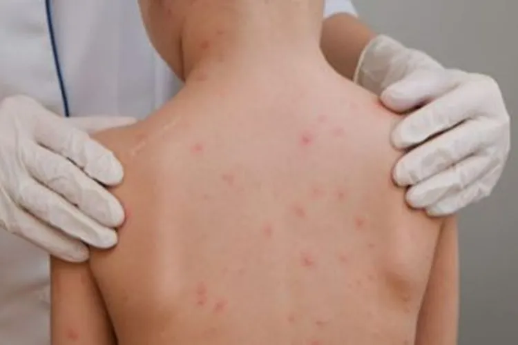 Meningite segue preocupando na Bahia