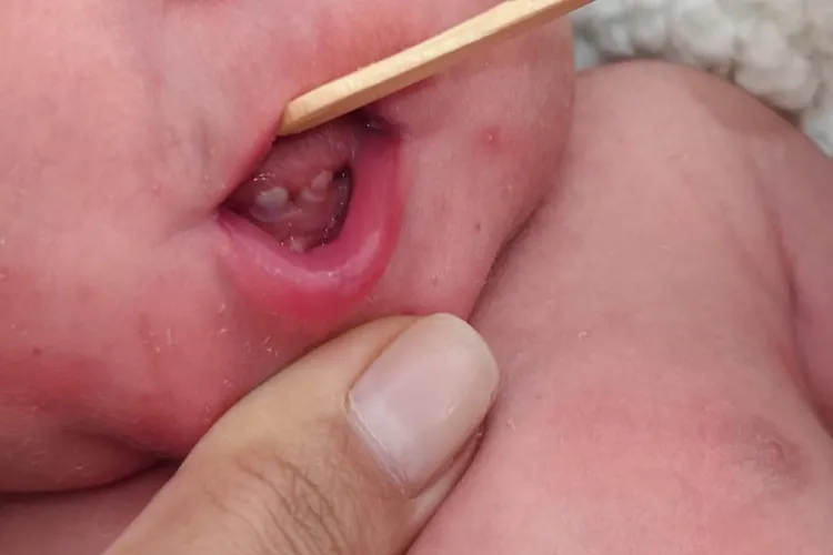 Fenômeno raro: Bebê impressiona ao nascer com dois dentes em Brumado