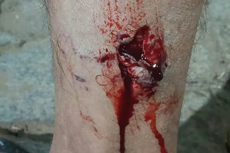Homem é atacado por matilha de cães em Livramento de Nossa Senhora