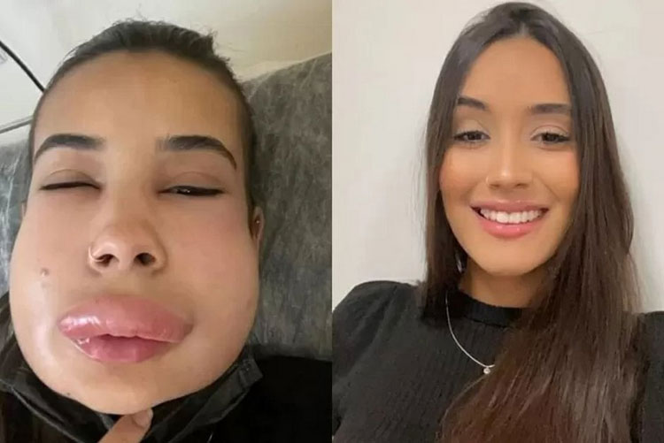 Estudante tem reação alérgica pós-procedimento estético e rosto incha no Tocantins