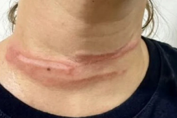 Fio solto quase tira a vida de motociclista em Livramento de Nossa Senhora