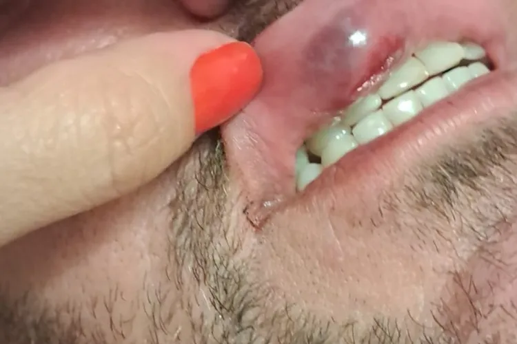 Folião denuncia agressão de Guarda Municipal durante o Carnaval de Brumado