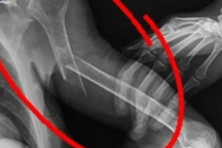 Idosa de 84 anos sofre fratura no braço durante atendimento em UPA de Caetité