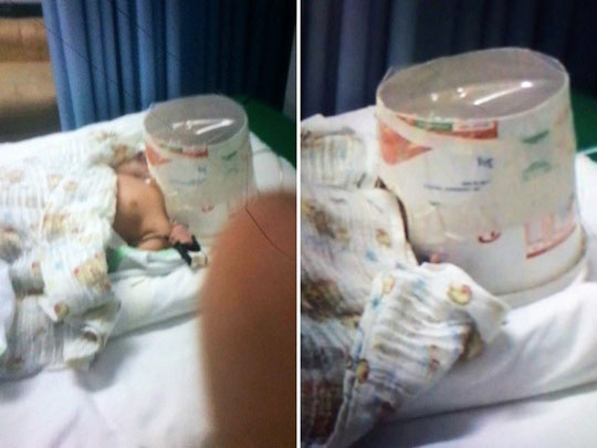 Natal: Bebê com suspeita de H1N1 respira com ajuda de pote de margarina