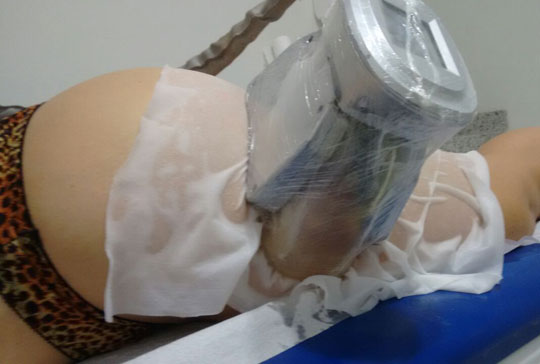 Últimas vagas para Criolipólise dia 05 de fevereiro na Clínica Mais Vida