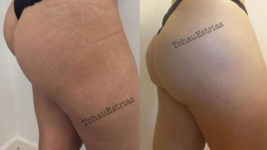 Tatuador brasileiro que camufla estrias faz sucesso internacional