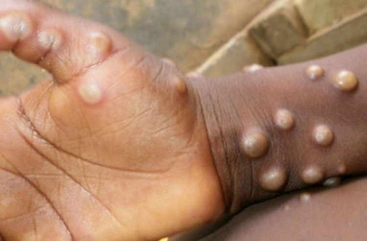 Sesab confirma 1º caso da varíola dos macacos no interior do estado