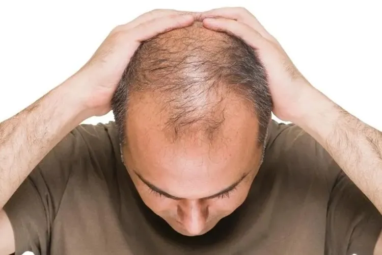 Pessoas com alopecia podem ganhar cirurgia gratuita pelo SUS