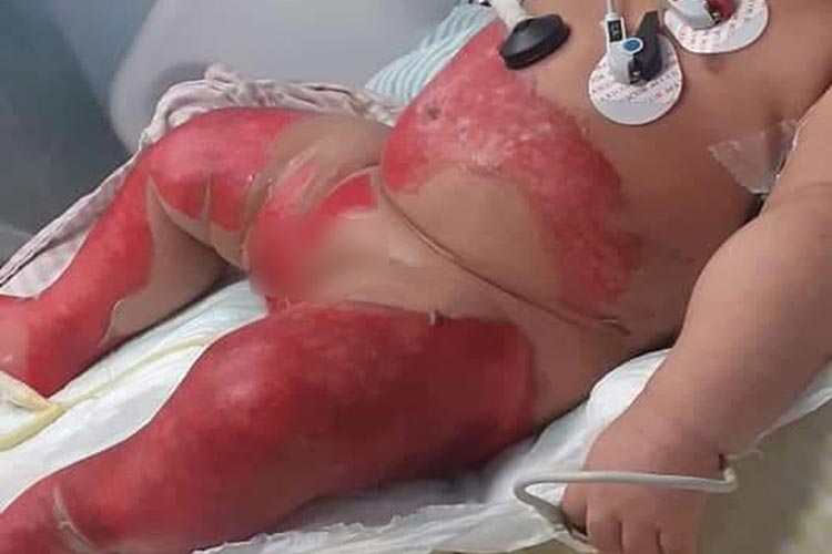 Bebê de 6 meses sofre queimaduras em hospital de Niterói