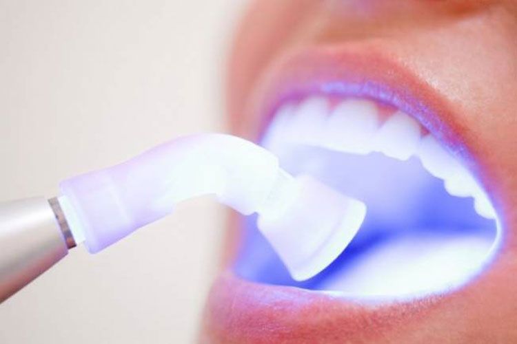 Clareamento dental é um dos procedimentos estéticos mais procurados durante o verão