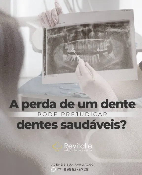 Revitalle explica consequências da não reposição de um dente perdido