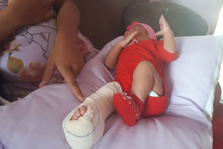 Bebê tem fratura no fêmur após cesárea no Hospital de Ipiaú