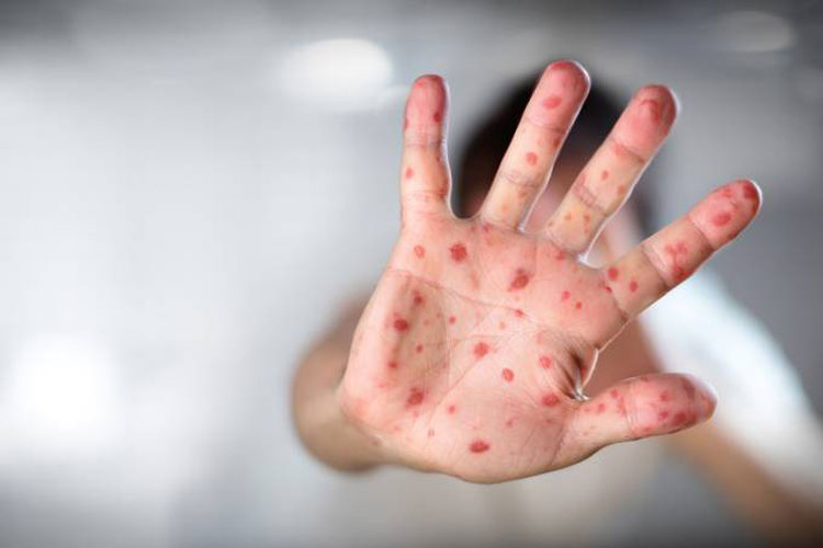 Ministério da Saúde confirma 1.100 casos de sarampo no Brasil