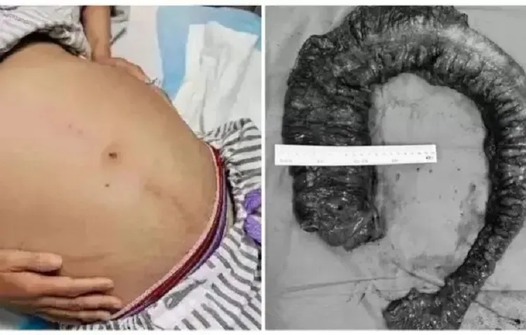 Médicos tiram fezes de 1 metro e 20 kg acumuladas no intestino de mulher na China