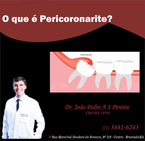 Pericoronarite: Confira as dicas do especialista João Pedro Amorim