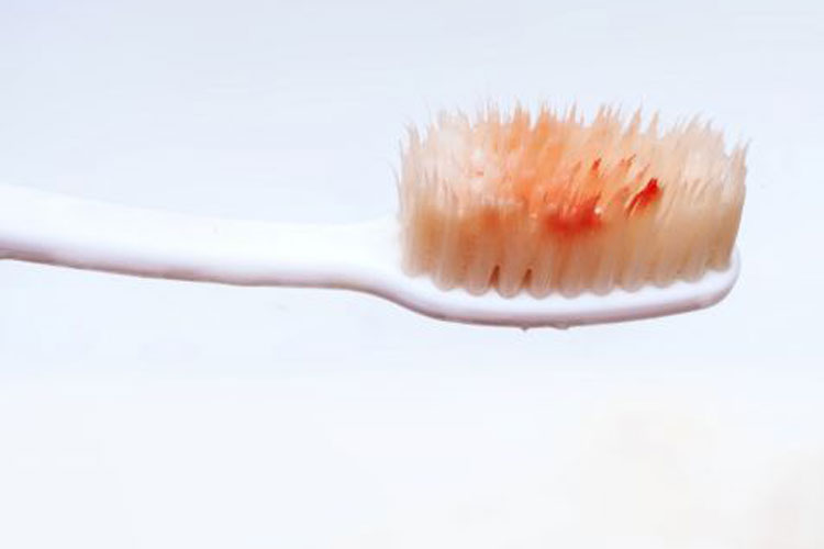 Higiene bucal: Por que a gengiva sangra ao escovar os dentes ou ao usar o fio dental?