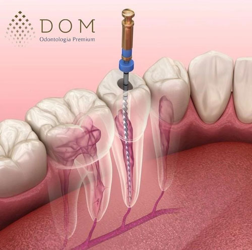 Tratamento de canal é na Dom Odontologia Premium em Brumado