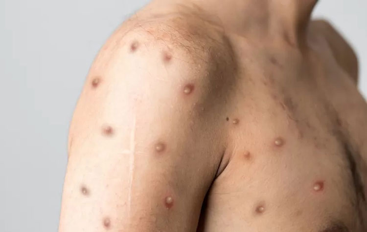 Ministério da Saúde diz que Brasil receberá antiviral contra varíola dos macacos