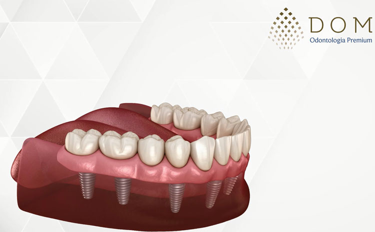 Conheça a prótese protocolo na Dom Odontologia Premium em Brumado