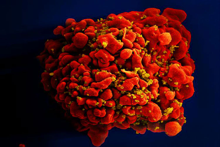 Crescem casos de HIV resistente ao tratamento