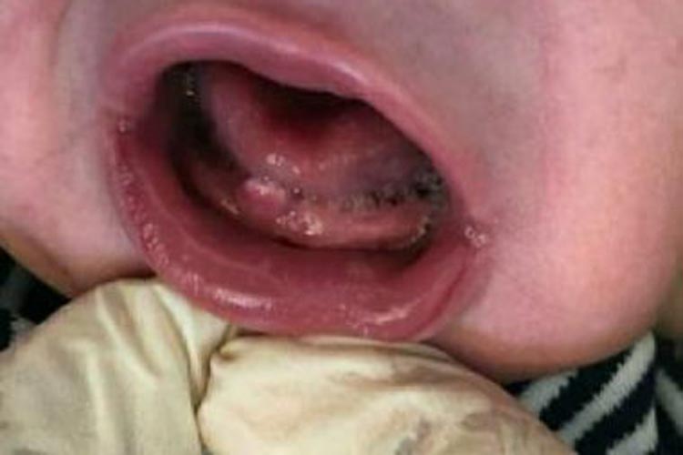 Bebê nasce com dente e surpreende funcionários de maternidade em Itororó