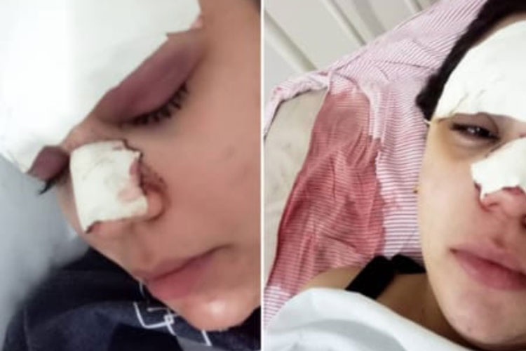 Barra da Estiva: Jovem de 22 anos fica com rosto desfigurado após ser agredida por amigo