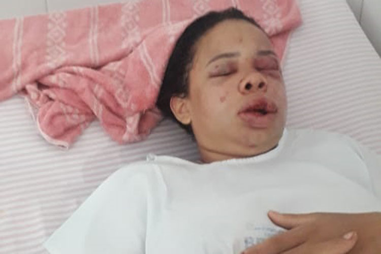 Brumado: Desfigurada, Helen continua internada sob sedação após ser espancada pelo ex-namorado