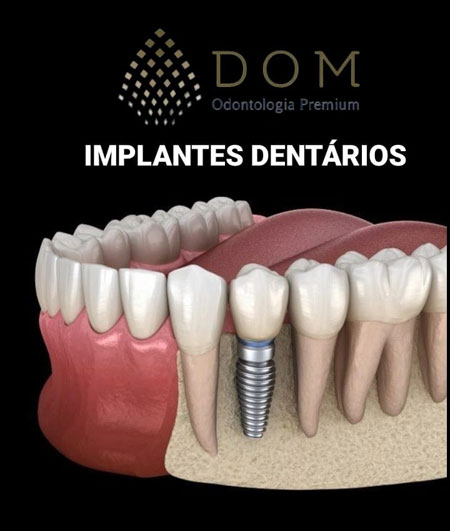 Implantes dentários é na Dom Odontologia Premium em Brumado