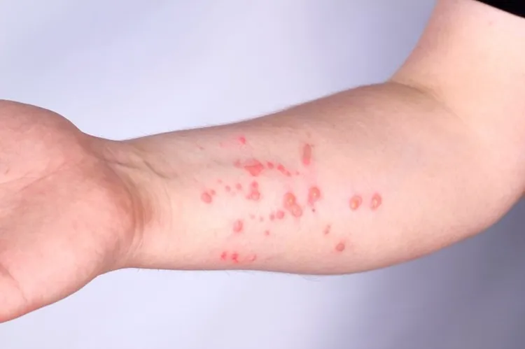 OMS alerta para variante mais perigosa de mpox