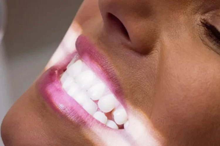 Anvisa determina proibição de fita para clareamento dental